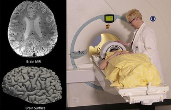 „Eisen-Atlas“ des Gehirns ermöglicht Alzheimer-Früherkennung